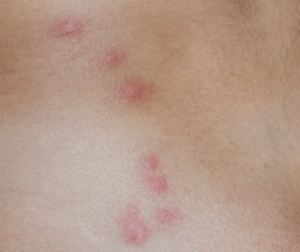 Bed Bug Bites always appear in a pattern. Choose BEAPCO