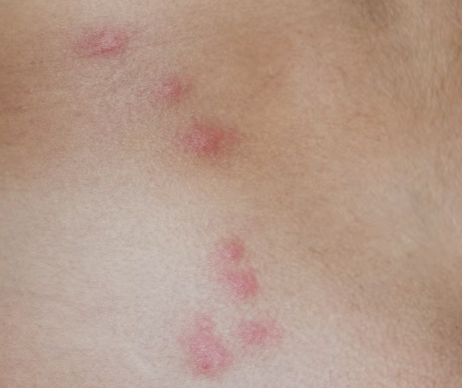 Bed Bug Bites always appear in a pattern. Choose BEAPCO