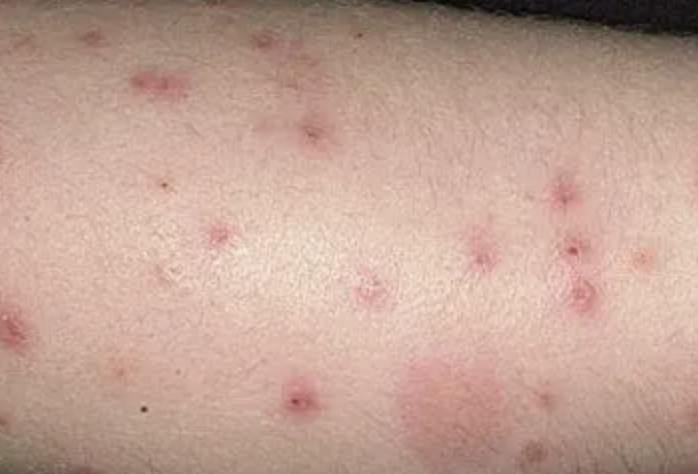 Flea Bites