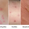 Bed Bug Bite vs. Flea Bite vs Mosquito Bite. Learn the difference and act swiftly