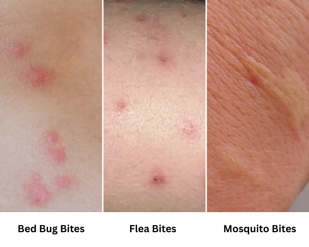 Bed Bug Bite vs. Flea Bite vs Mosquito Bite. Learn the difference and act swiftly