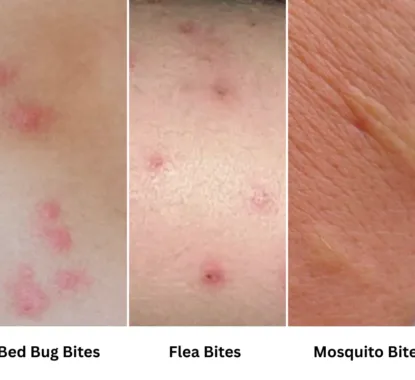 Bed Bug Bite vs. Flea Bite vs Mosquito Bite. Learn the difference and act swiftly